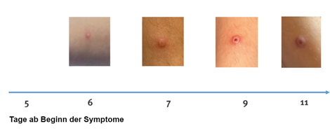 Hautveränderungen bei Mpox/Affenpocken im Zeitverlauf. Quelle: Antinori A, 2022/Eurosurveillance