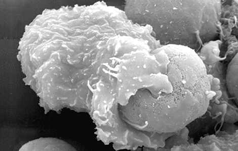 Balamuthia mandrillaris Amöbe attackiert eine Maus-Zelle (Mastozytom Zelllinie P815). Raster-Elektronenmikroskopie. Quelle: © Dr. Muhsin Özel, RKI (Kiderlen et al. 2006 J Eukaryotic Microbiology 53:456-463)